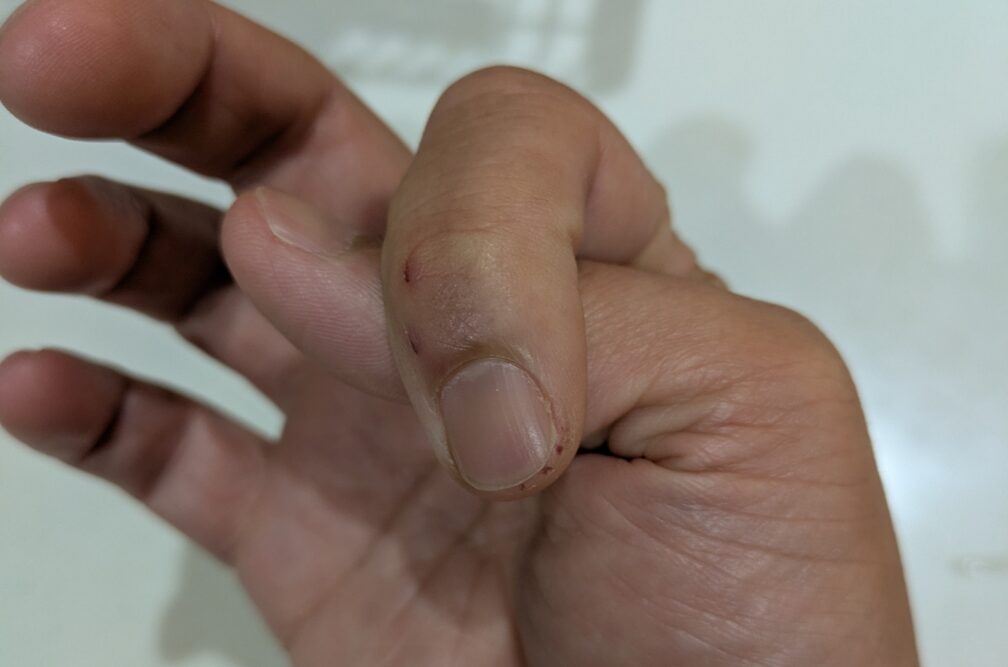 タチウオにかまれた指